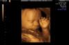 Massachusetts Bill Would Expand Abortions Up to Birth