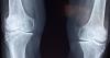 Society of Interventional Radiology endorses treatment for symptomatic knee osteoarthritis