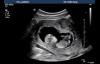 Arkansas Has Passed 63 Laws Saving Babies From Abortion