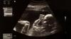 Wyoming Judge Blocks Heartbeat Law Saving Babies From Abortions