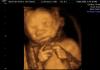 El País Discovers a New Form of “Extremism”: Letting a Mother Hear Her Baby’s Heartbeat