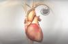 Orchestra BioMed targets completed BACKBEAT enrollment by end of Q3 2026
