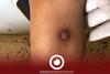 Libyan Red Crescent rejects reports of leishmaniasis cases in Ghat