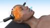 Experts Raise Concerns Over Use of ECT in Australia
