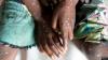 Ghana records 13 new Mpox cases, total reaches 947