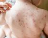 Measles, once eliminated by vaccine, returning to US