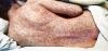 Fifth Measles Case Reported in Georgia
