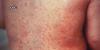 Measles cases in Arizona raise concerns over indigenous immunization rates