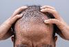 Can baldness be cured? Scientists may have discovered how to unlock hair regrowth
