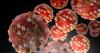 Measles cases reported in four Montana counties this year