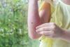 First 2025 West Nile Virus Infections Detected in Greece