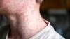 IDPH holds update on measles in Illinois as cases across U.S. keep rising