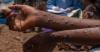 Gambia announces mpox outbreak