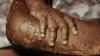 Mpox cases decline, new outbreaks detected — Africa CDC