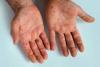 Mpox cases drop, new outbreaks detected — Africa CDC