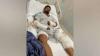 Honduran Worker Suffers Severe Injuries After High-Voltage Electrocution in Stann Creek