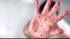 First measles case in more than 30 years confirmed in northern Idaho