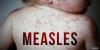Colorado child hospitalized after testing positive for measles