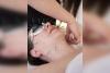 In the age of #notox, can cosmetic acupuncture be the new Botox?