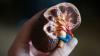 Scientists reveal new ways to predict course of chronic kidney disease