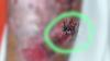 Ministry of Health confirms first human infected with the new world screwworm in Belize