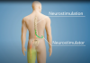Guam Regional Medical City introduces first smart spinal cord stimulator for chronic pain relief