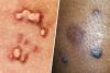 Human Papilloma Virus (HPV) Routine Vaccination Starting Soo...