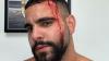 Israeli man attacked by pro-Palestinian crowd in Los Angeles