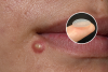 Scientists Invent Patch That Makes Pimples 'Disappear' Pain-Free