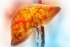 Scientists Unveil Potential First-of-Its-Kind Treatment for Deadly Fatty Liver Disease