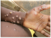 Three new Mpox cases detected in Barbados