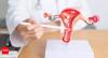Ovarian cancer diet and lifestyle guide: Foods, fitness, and wellness tips