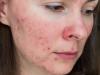 <![CDATA[Unveiling the Psychosocial Impact and Lifestyle Factors Associated with Rosacea in China]]>