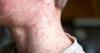 Minnesota's measles case count jumps to 20