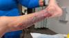 New case of 'flesh-eating bacteria' reported in Florida