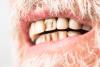 Scientists Discover Stem Cells That Could Regenerate Teeth and Bone