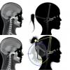 Neural Tube and Orofacial Malformations: Chile’s RENACH Data