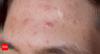 What causes forehead acne: Know common triggers, hormones, and lifestyle factors