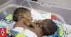 Conjoined twins in Papua New Guinea 'have a will to live' but face uncertain future