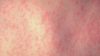 One new measles case reported in South Carolina's Upstate