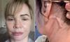 Businesswoman who flew to Lithuania for a £7,000 face and necklift to 'feel younger' says she was left scarred and with hearing loss and a 'lopsided' mouth