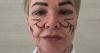 Botched £8k facelift leaves Ayrshire woman with 'lopsided mouth' after travelling to Lithuania