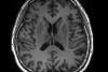 This early Alzheimer’s sign could be hiding in your routine scans, scientists say