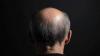 South Korean Leader Floats Insurance Coverage for Hair Loss, Sparking Debate