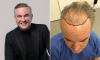 'People call it a midlife crisis, I call it clarity': NICK EDE reveals how a 'brutal' 14-hour hair transplant helped save him from suicidal thoughts where Botox, veneers and THREE nose jobs failed