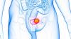 Diabetes Tied to Worse Bladder Cancer Survival in Finland