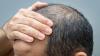 Wonder drug for male baldness puts Swiss firm Cosmo's shares on steroids