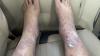 ‘Ruined my trip’: Woman claims fungal infection after Akasa Air travel, airline responds