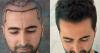 Top 10 Best Hair Transplant Clinics in Turkey for 2026
