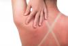 Scientists Discover How Sunburn Triggers a Hidden Cancer Chain Reaction